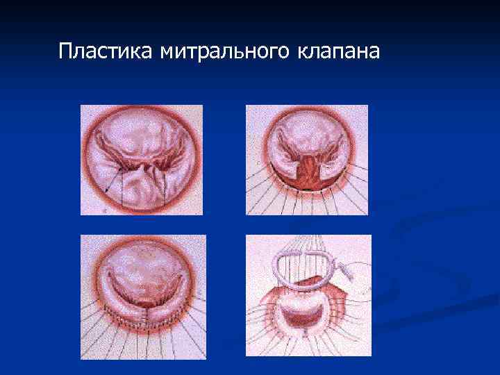 Пластика митрального клапана 