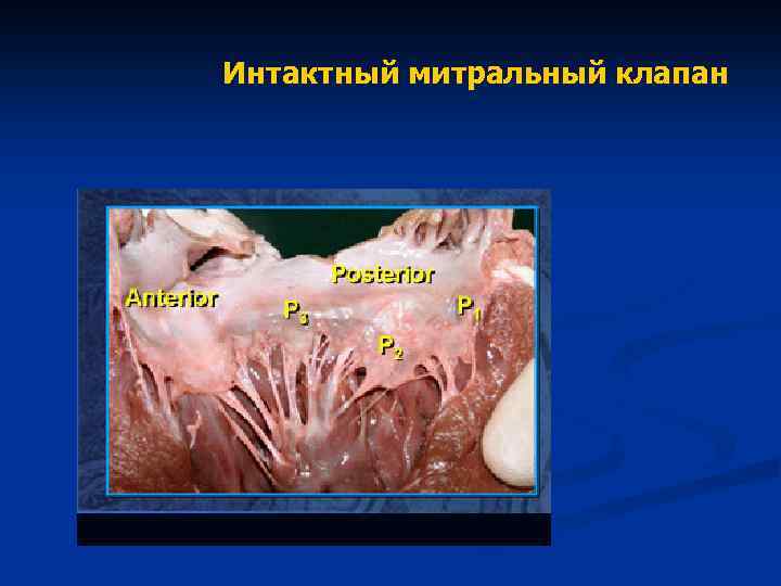 Интактный митральный клапан 