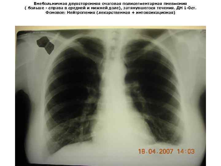 Двусторонняя пневмония. Полисегментарная двухсторонняя пневмония рентген. 2ст полисегментарная пневмония. Полисегментарная пневмония кт3. Полисегментарная пневмония s1-s2.