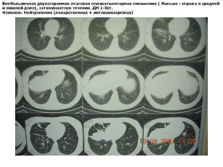 Внебольничная двухсторонняя очаговая полисегментарная пневмония ( больше - справа в средней и нижней доле),