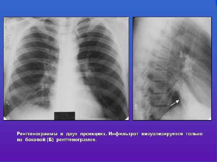 Двухсторонняя пневмония фото