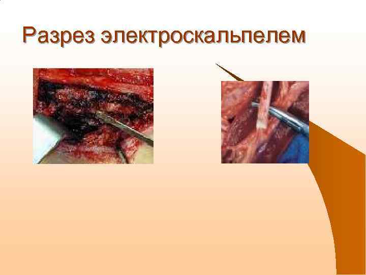 Разрез электроскальпелем 