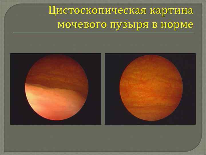 Цистоскопическая картина мочевого пузыря в норме 