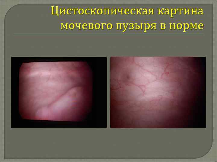 Цистоскопическая картина мочевого пузыря в норме 