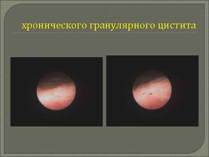хронического гранулярного цистита 