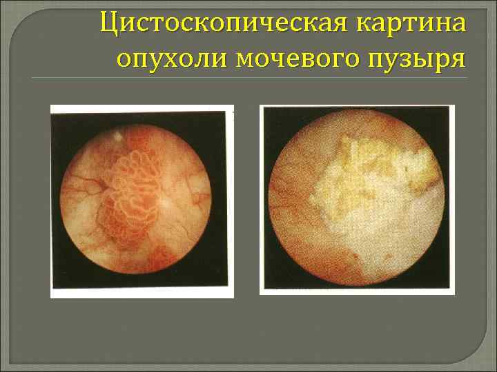 Цистоскопическая картина опухоли мочевого пузыря 