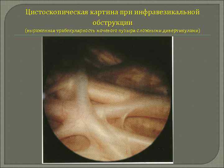 Цистоскопическая картина при инфравезикальной обструкции (выраженная трабекулярность мочевого пузыря с ложными дивертикулами) 