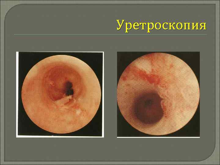 Уретроскопия 