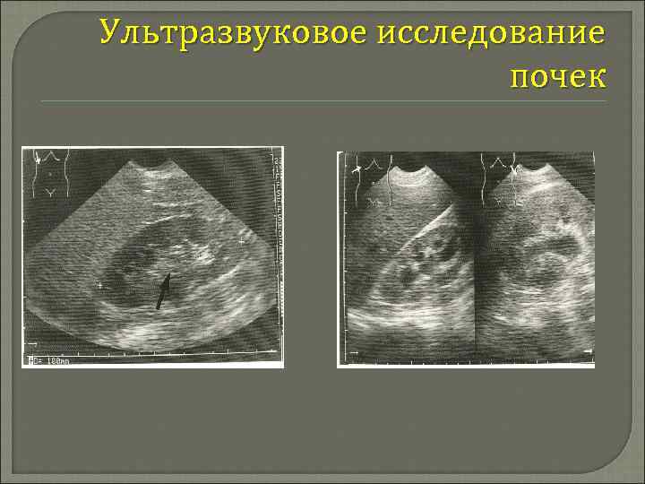 Эхографическая картина почек