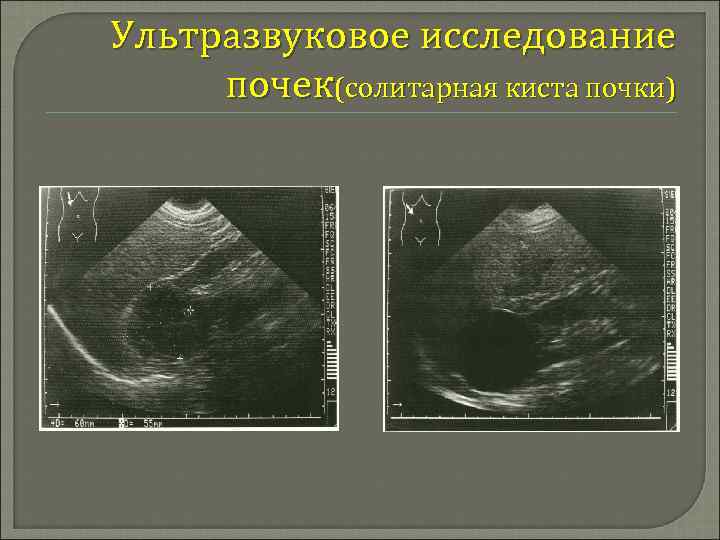 Эхографическая картина почек