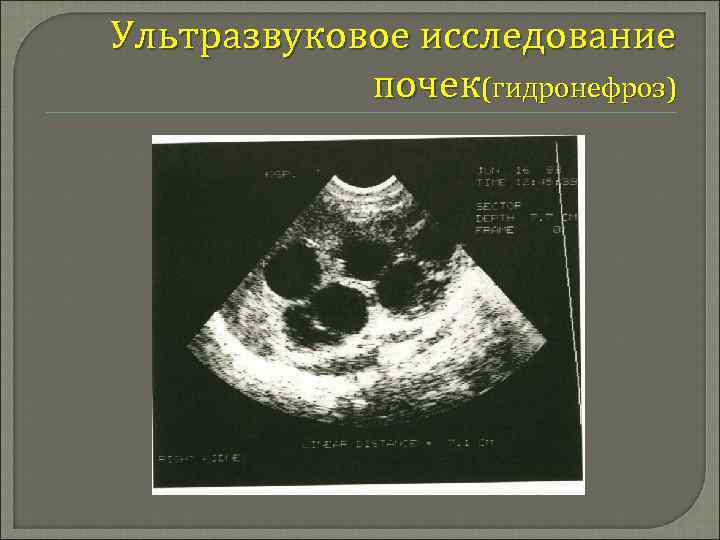 Ультразвуковое исследование почек(гидронефроз) 