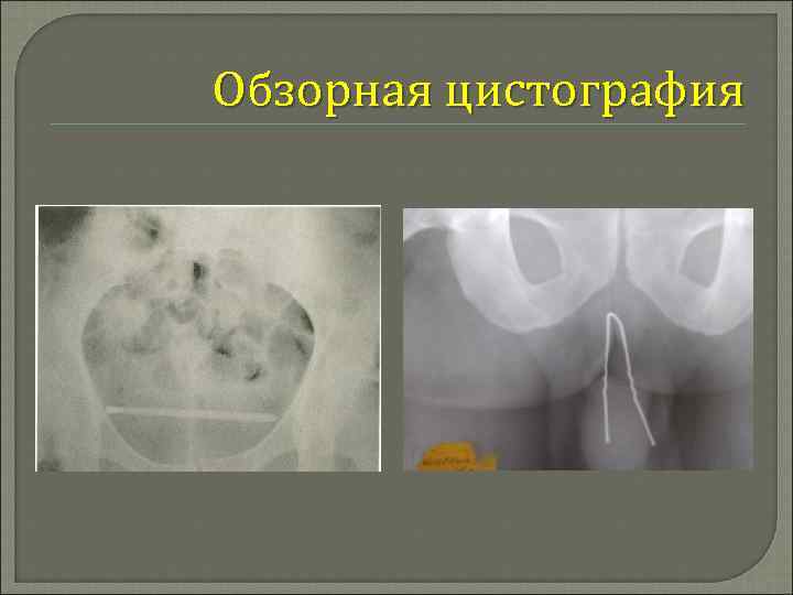 Обзорная цистография 