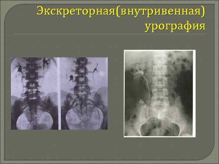 Экскреторная урография презентация