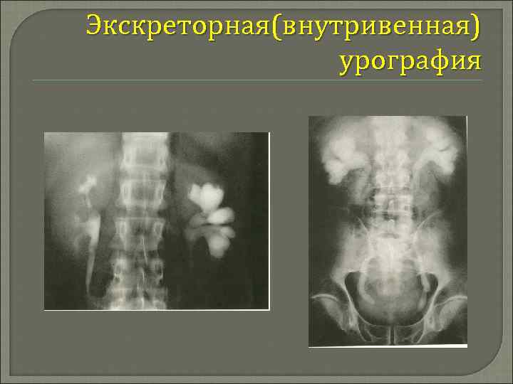 Внутривенная урография презентация