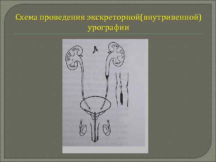 Схема проведения экскреторной(внутривенной) урографии 
