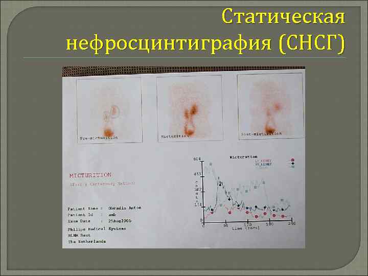 Статическая нефросцинтиграфия (СНСГ) 