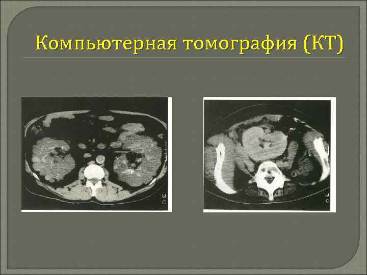 Компьютерная томография (КТ) 