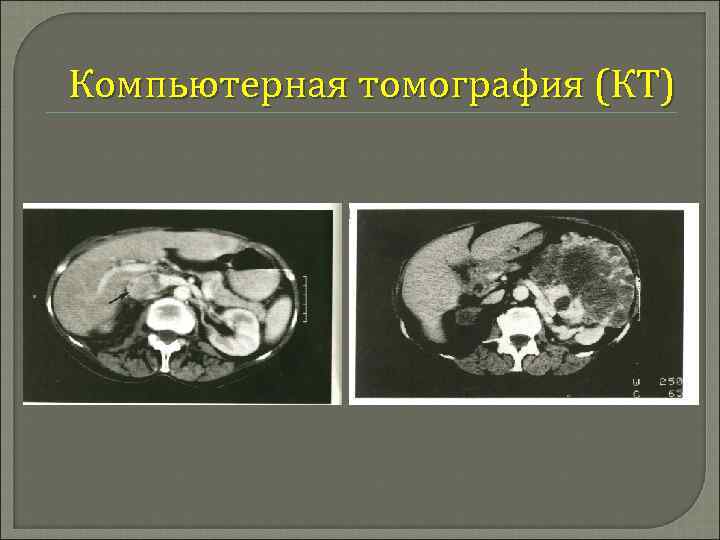 Компьютерная томография (КТ) 
