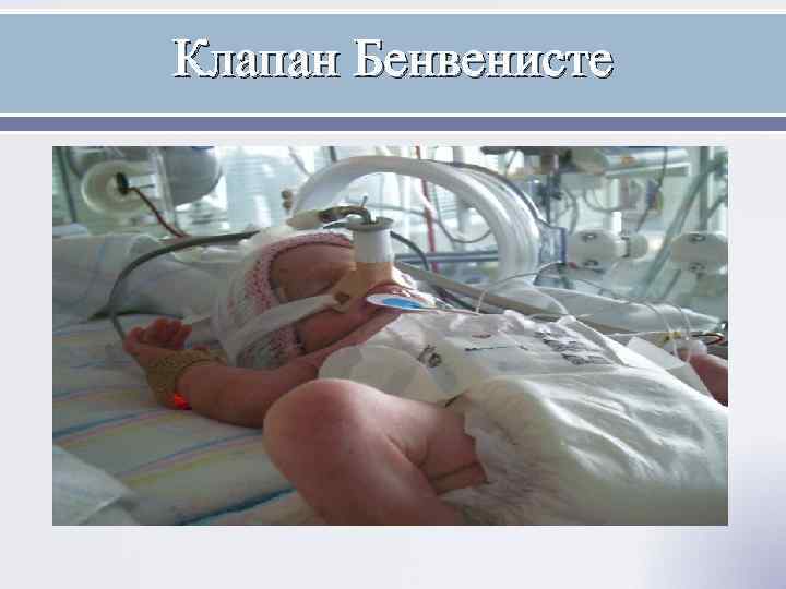 Клапан Бенвенисте 