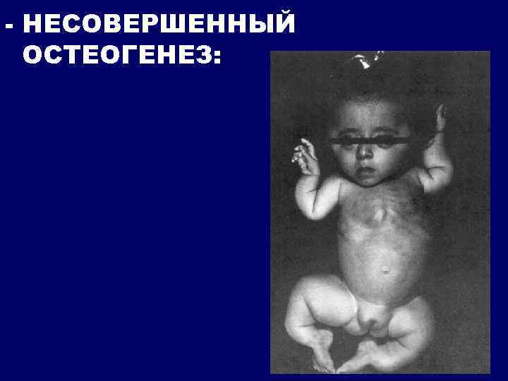 - НЕСОВЕРШЕННЫЙ ОСТЕОГЕНЕЗ: 