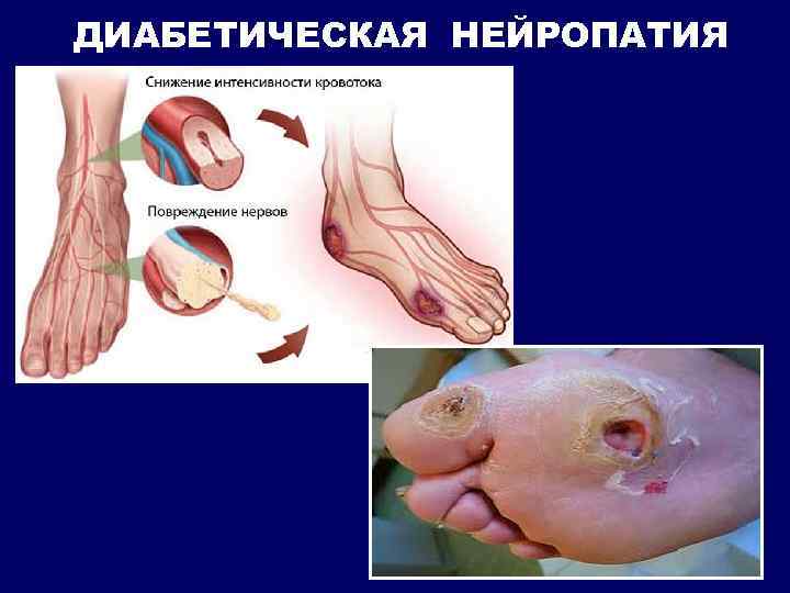 ДИАБЕТИЧЕСКАЯ НЕЙРОПАТИЯ 