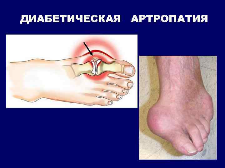 ДИАБЕТИЧЕСКАЯ АРТРОПАТИЯ 