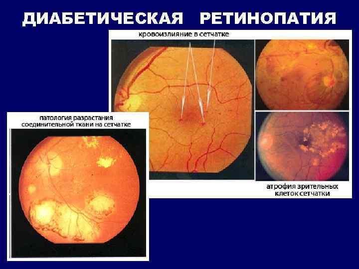 ДИАБЕТИЧЕСКАЯ РЕТИНОПАТИЯ 