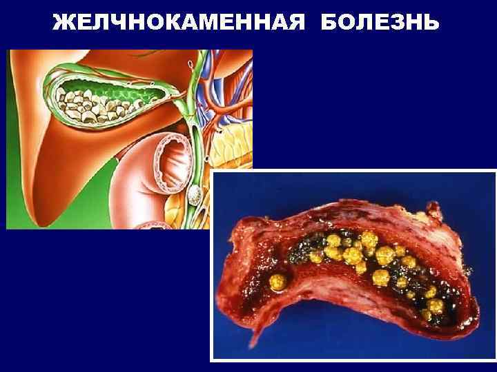 ЖЕЛЧНОКАМЕННАЯ БОЛЕЗНЬ 