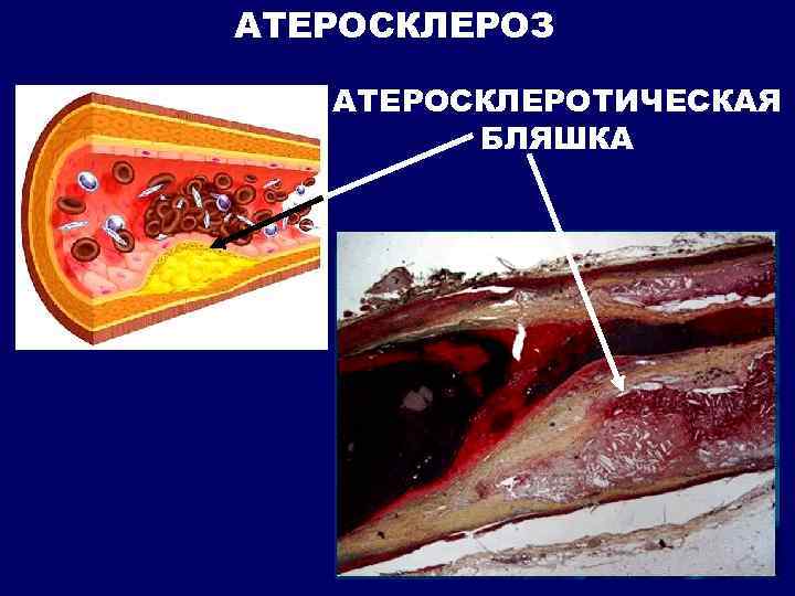 АТЕРОСКЛЕРОЗ АТЕРОСКЛЕРОТИЧЕСКАЯ БЛЯШКА 