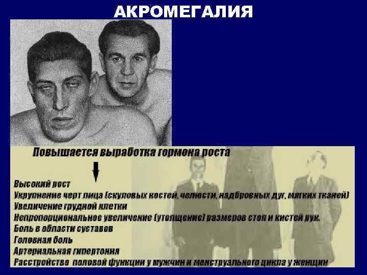 АКРОМЕГАЛИЯ 