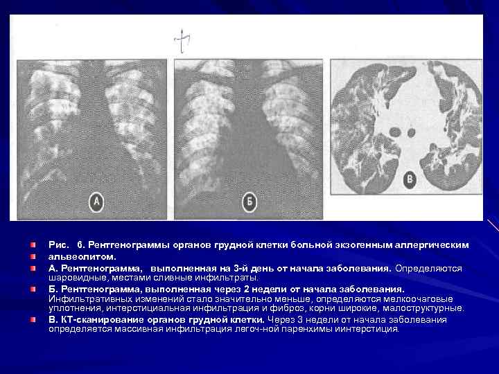 Г. КТ сканирование на уровне бифуркационного среза. Вентиляционная функция легких, несмотря на массивную инфильтрацию,