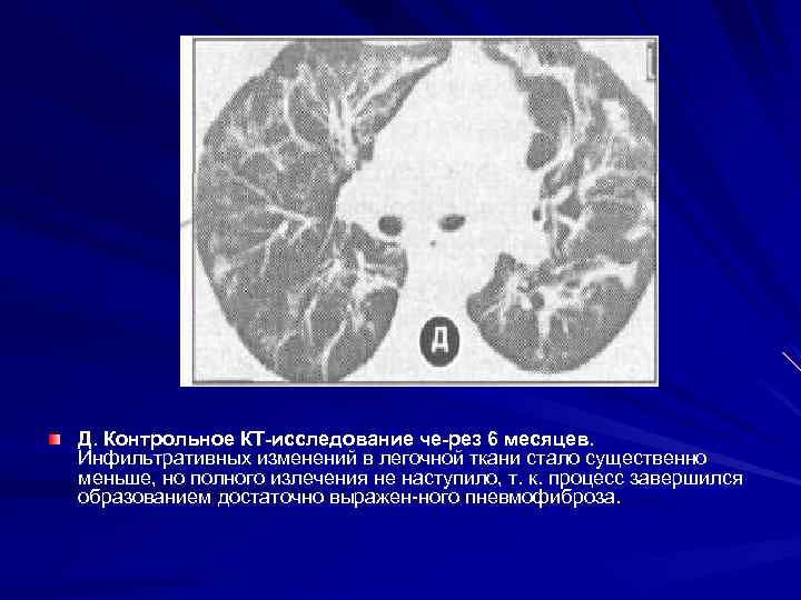  ИФА Этиология неизвестна. это иммунопатологическое состояние с развитием гиперэргических реакций болезнь рассматривается как
