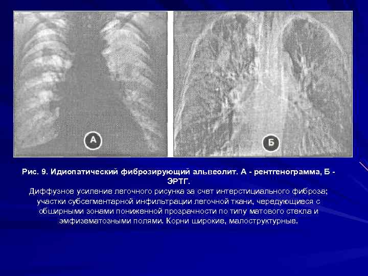 Фиброз обеих легких. Идиопатический легочный фиброз рентген. Интерстициальные заболевания легких рентген. Фиброзирующий альвеолит препарат. Кт картина фиброзирующего альвеолита легких.