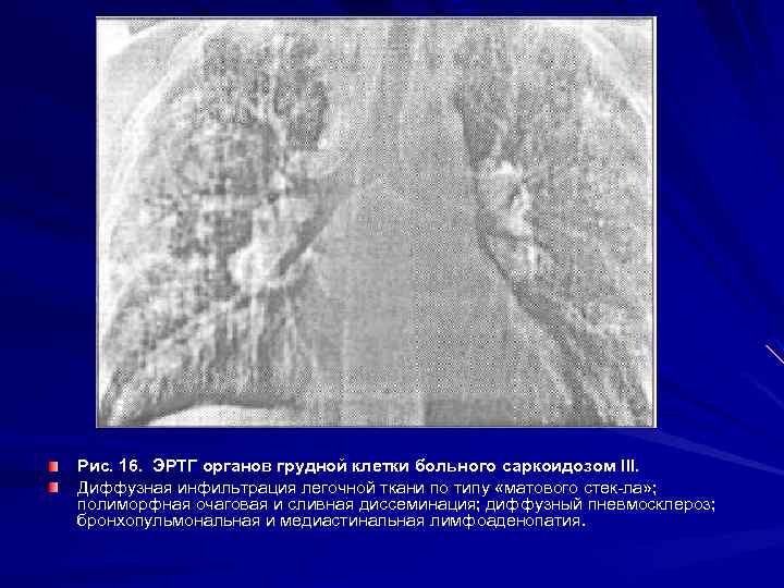  Основные критерии дифференциальной диагностики гистиоцитарного гранулематоза, диссеминированного туберкулеза легких и саркоидоза органов дыхания
