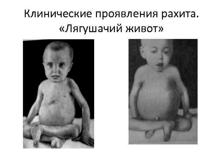 Клинические проявления рахита. «Лягушачий живот» 