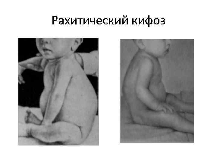 Рахитический кифоз 