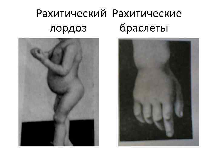 Рахитический Рахитические лордоз браслеты 