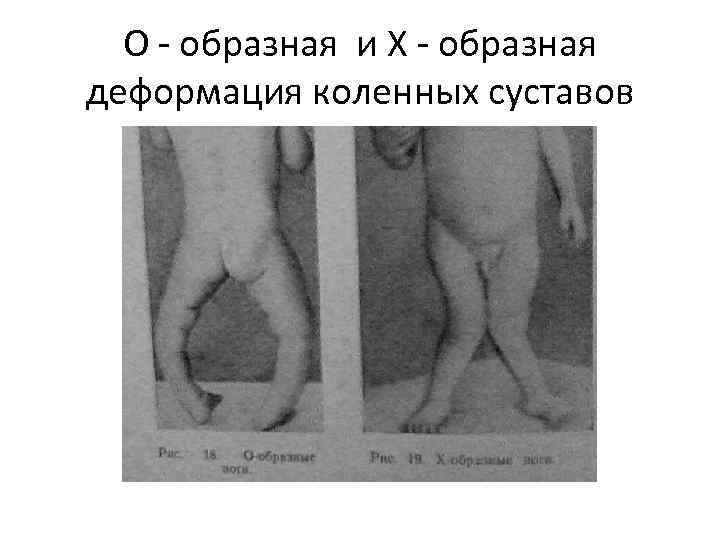 О - образная и Х - образная деформация коленных суставов 