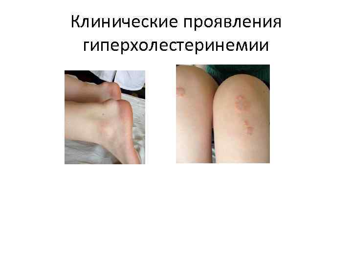Клинические проявления гиперхолестеринемии 