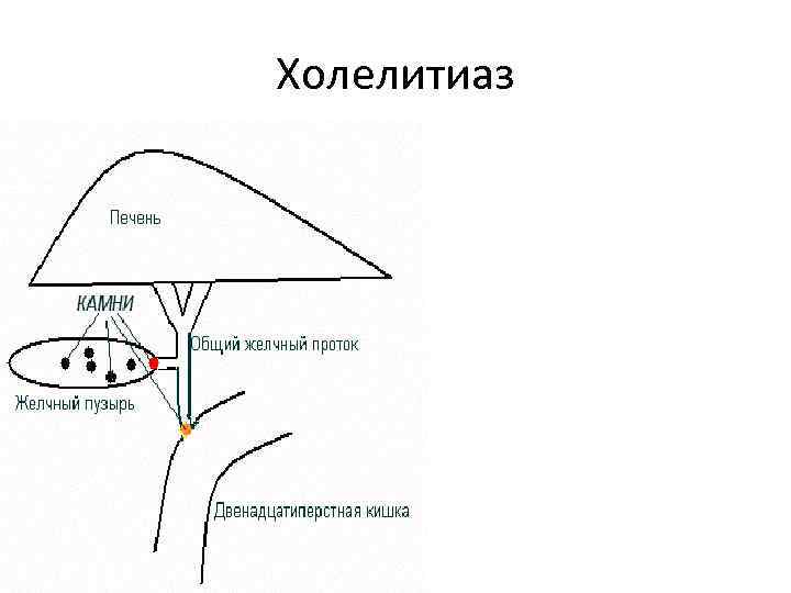 Холелитиаз 