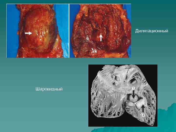 Дилятационный Шаровидный 