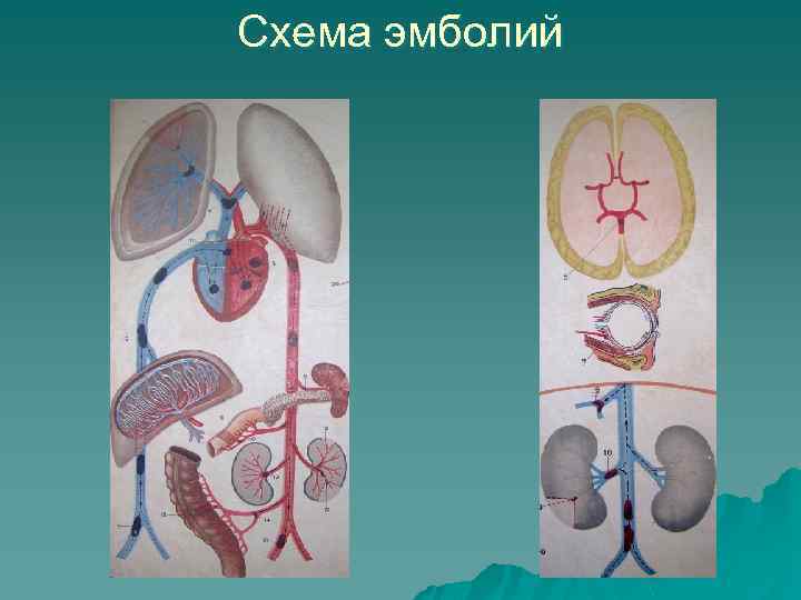 Схема эмболий 