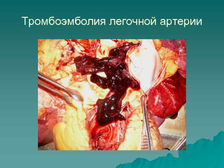 Тромбоэмболия легочной артерии 