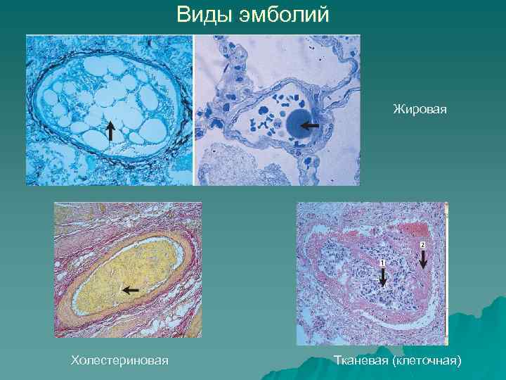 Виды эмболий Жировая Холестериновая Тканевая (клеточная) 