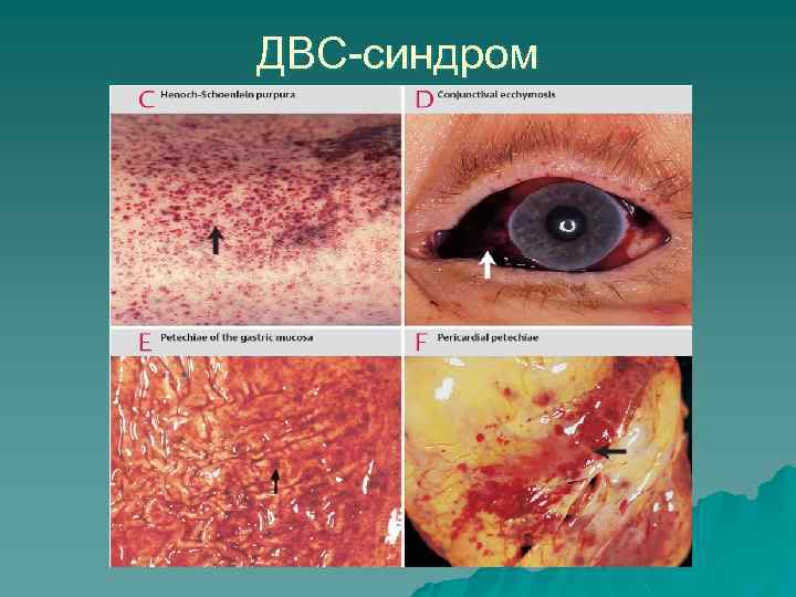 ДВС-синдром 