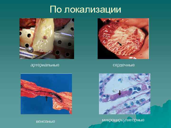 По локализации артериальные сердечные венозные микроциркуляторные 