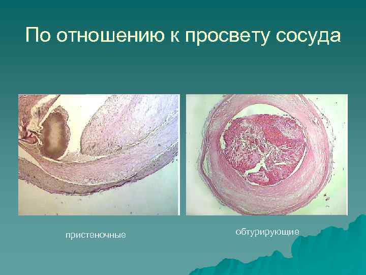 По отношению к просвету сосуда пристеночные обтурирующие 