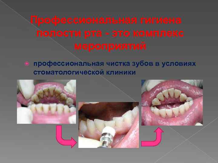Профессиональная гигиена полости рта - это комплекс мероприятий профессиональная чистка зубов в условиях стоматологической