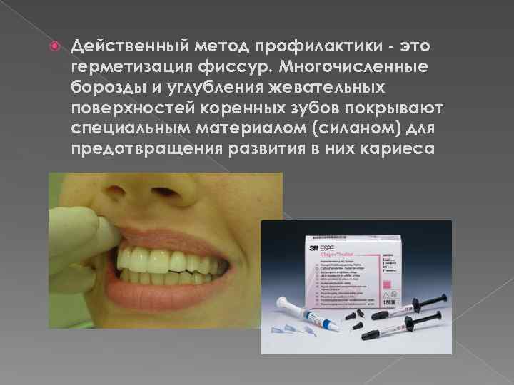  Действенный метод профилактики - это герметизация фиссур. Многочисленные борозды и углубления жевательных поверхностей