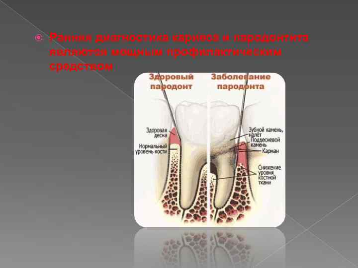  Ранняя диагностика кариеса и пародонтита являются мощным профилактическим средством 